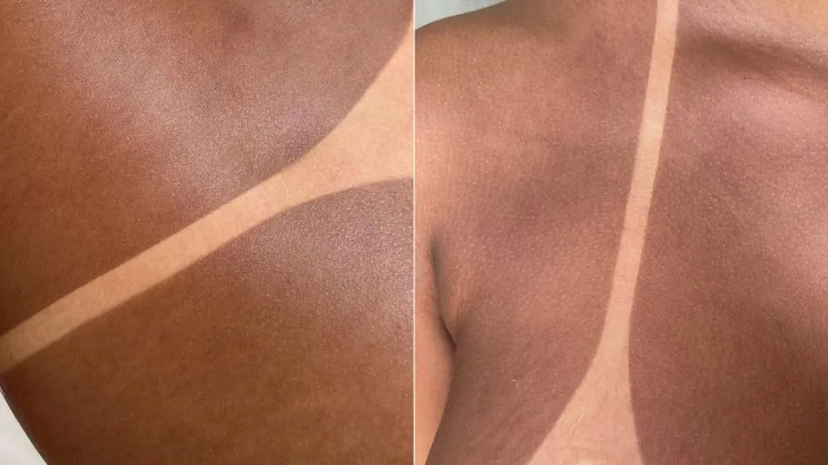 Marcas de bronzeamento definidas na pele
